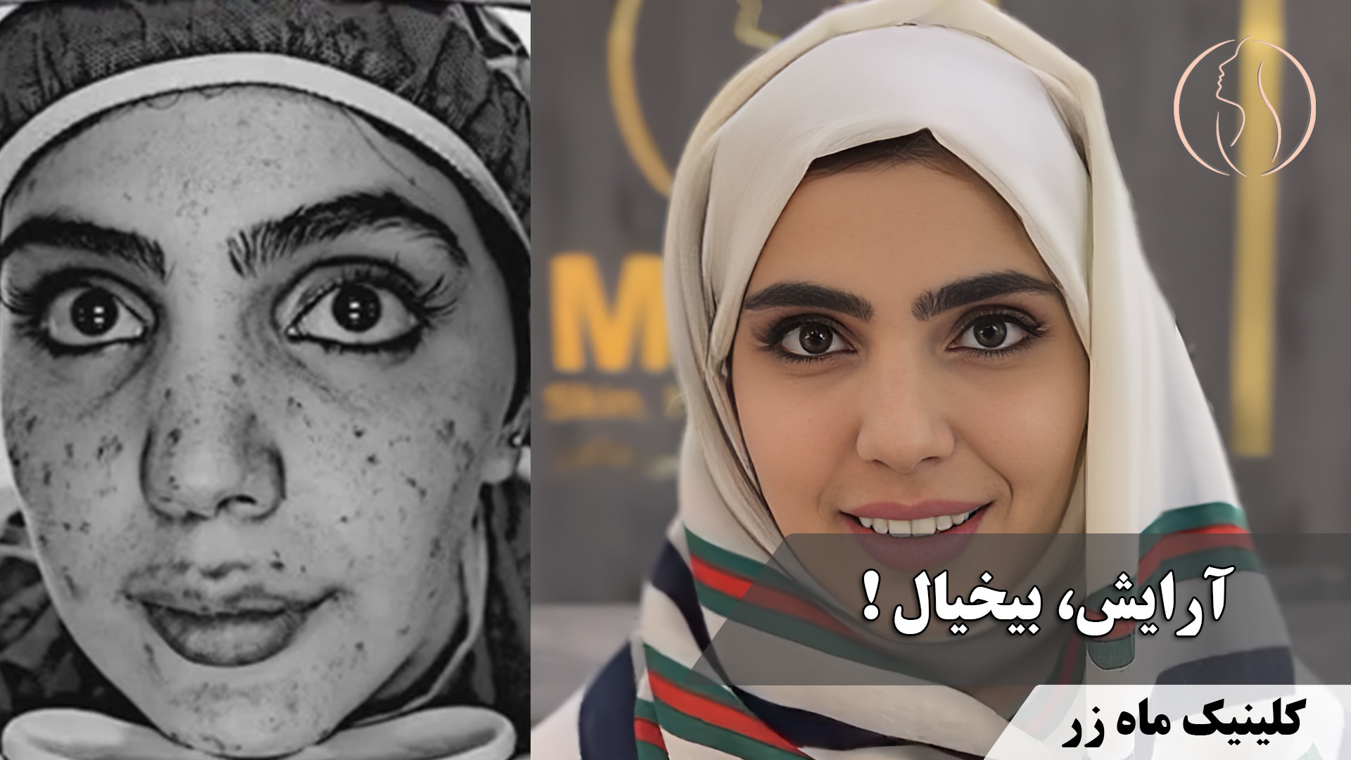 وقتی از آرایش دست کشیدم و خودم شدم! ( کلینیک زیبایی ماه زر ) جراحی گوش