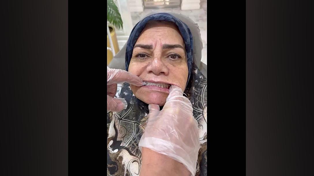 فیلم گذاشتن دندان مصنوعی برای لثه تحلیل رفته پلاسماجت