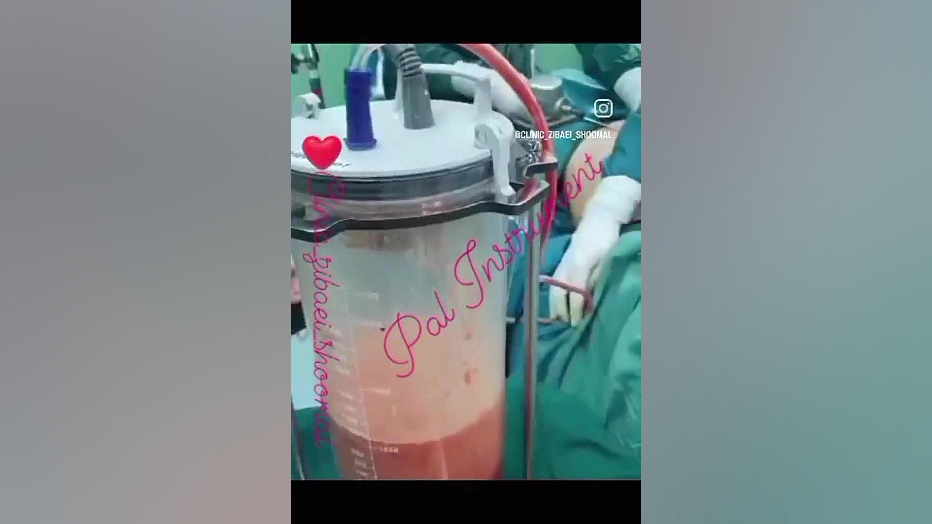 دستگاه لیپوساکشن Vibralipo1 FEV1