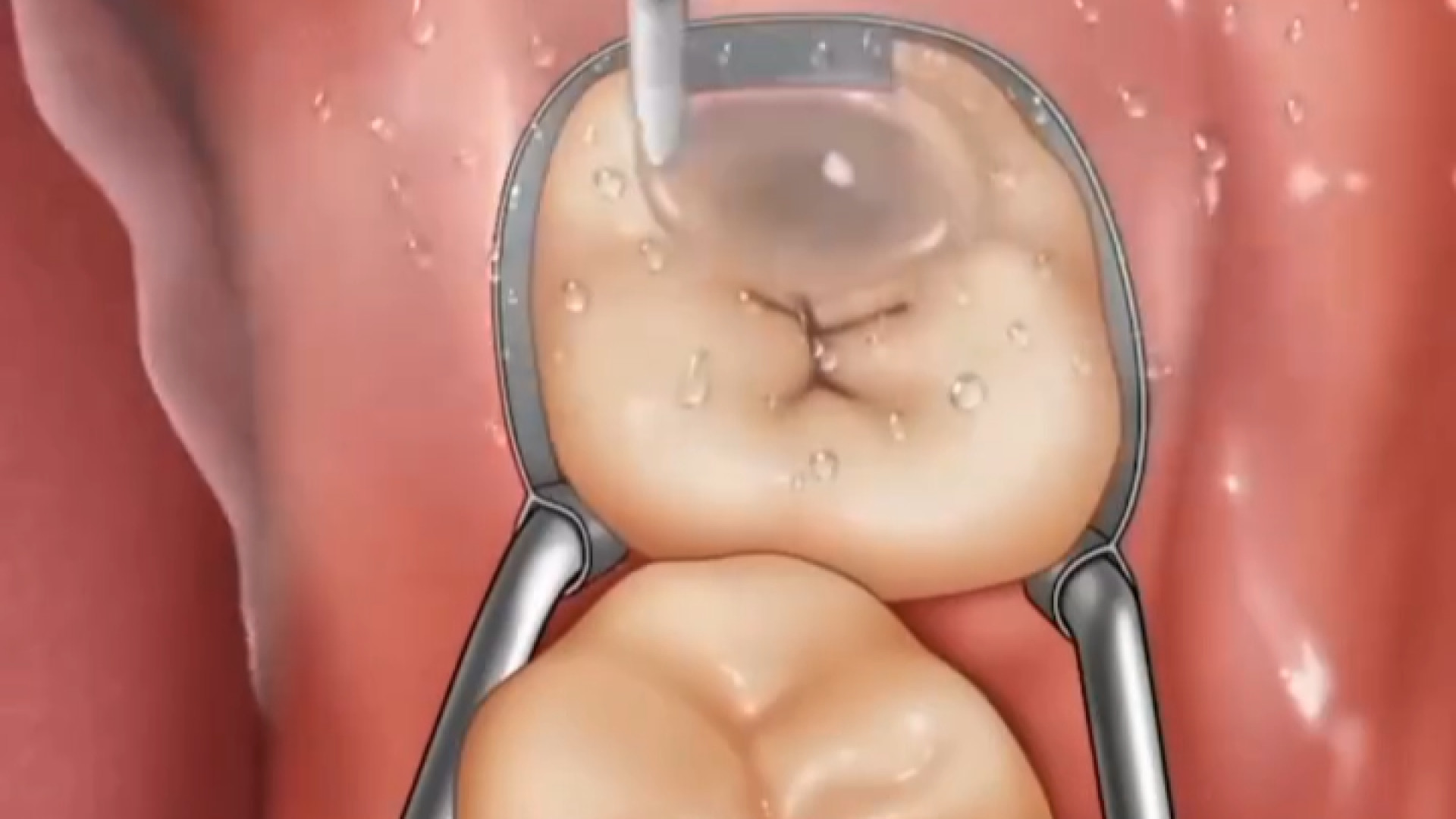 مراحل پر کردن دندان Organoid Viability Test