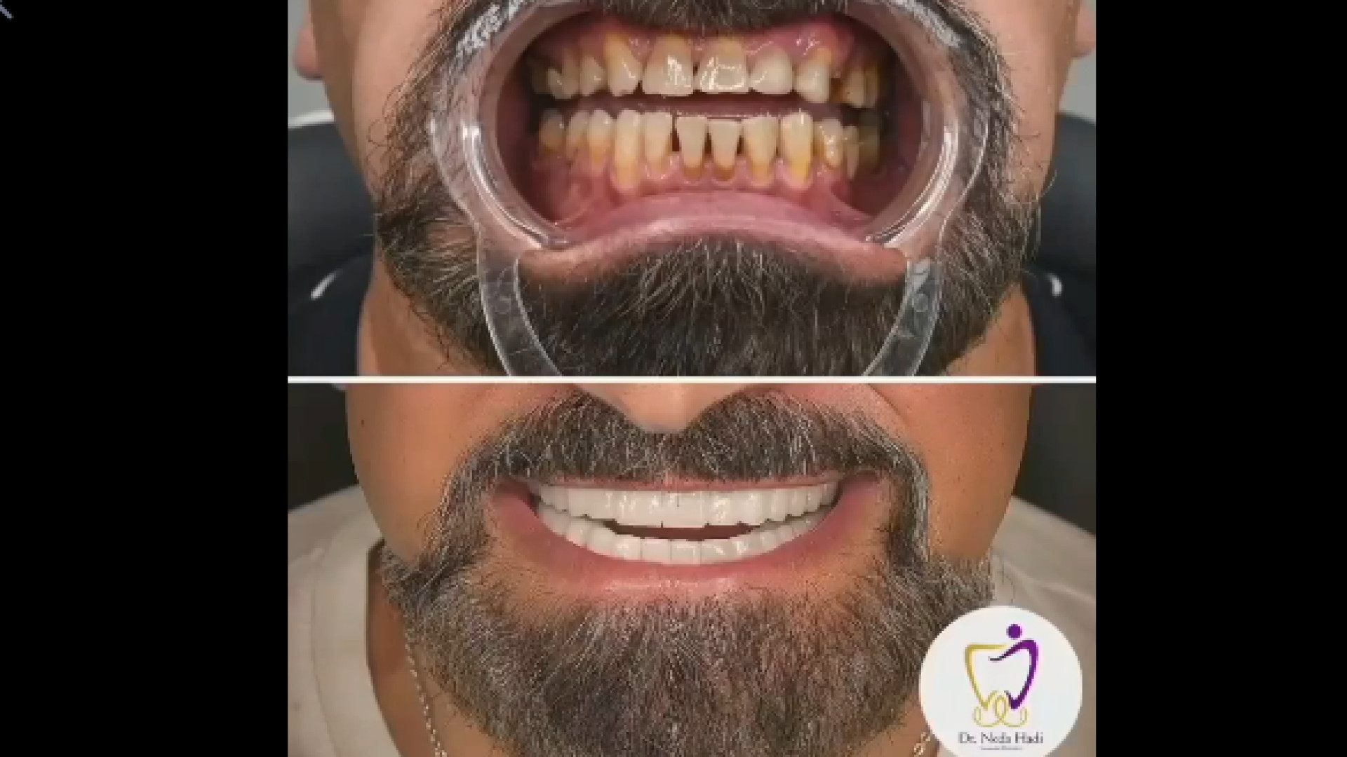 کامپوزیت دو فک دکتر ندا هادی-دندانپزشک زیبایی