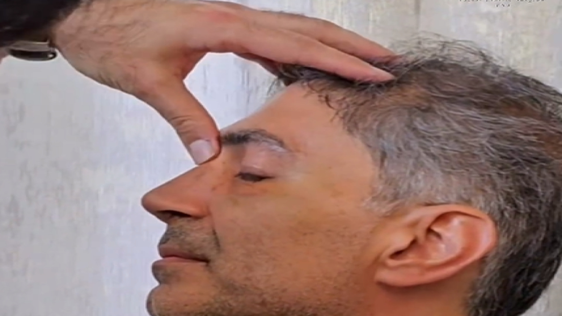 نتیجه شگفت انگیز و و فوق العاده بلافاصله بعد از برداشتن گچ دکتر علی عقیلی - جراح بینی در تهران