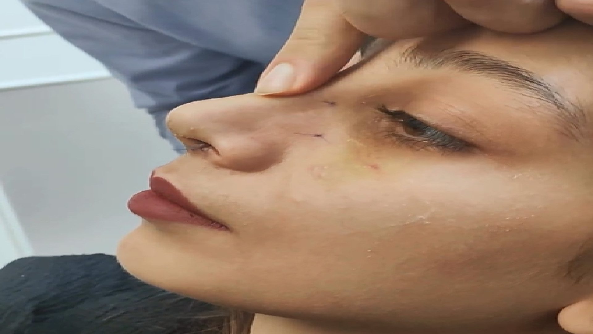 نتیجه جراحی بینی بلافاصله بعد از برداشتن گچ دکتر علی عقیلی - جراح بینی در تهران