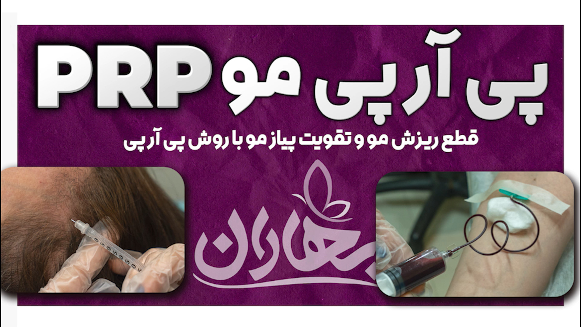 پی آر پی مو PRPمو درمان ریزش مو و تقویت پیاز مو در کلینیک زیبایی مشهد بهاران مرکز جراحی کسری ،کلینیک بهاران ، دندانپزشکی نیکان