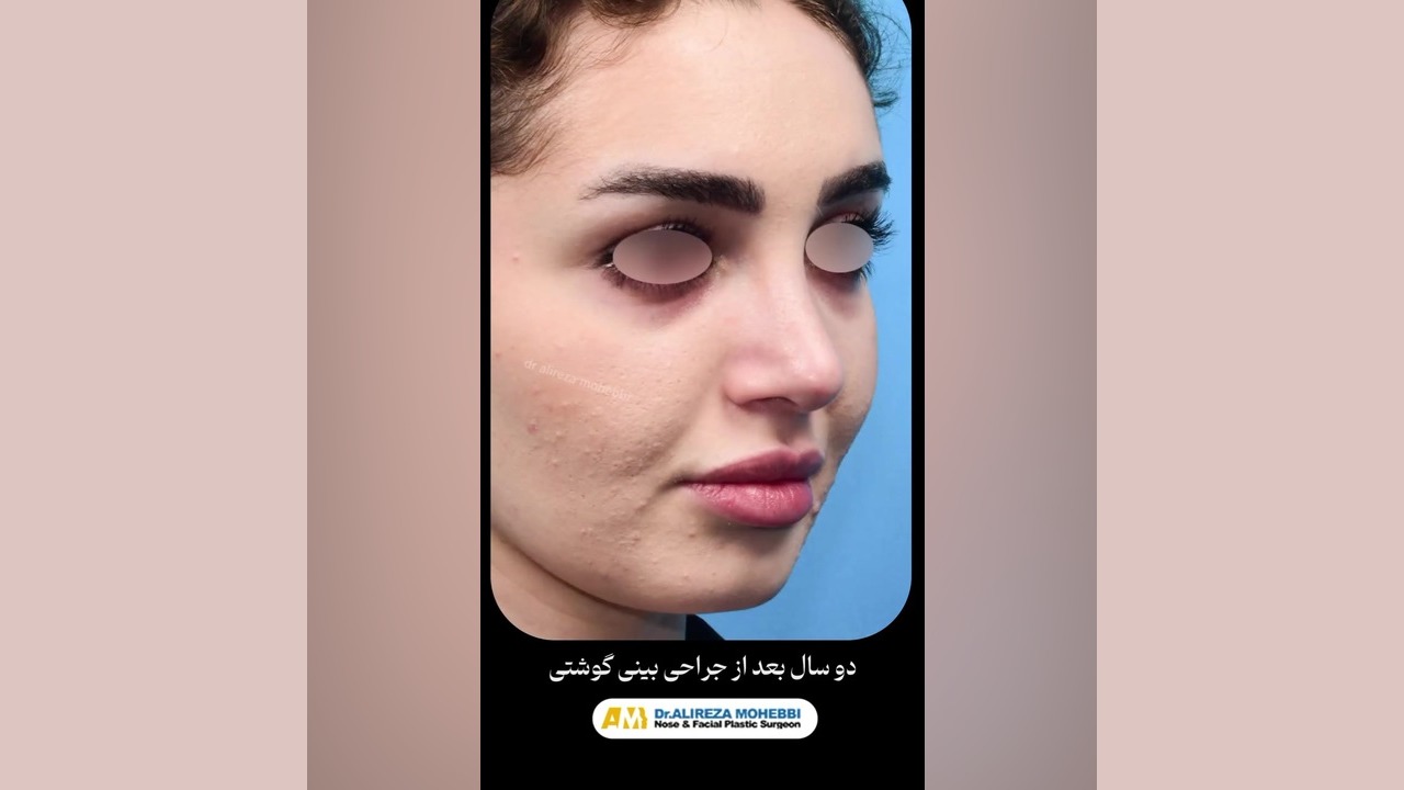 دو سال بعد از عمل بینی با دکتر محبی
