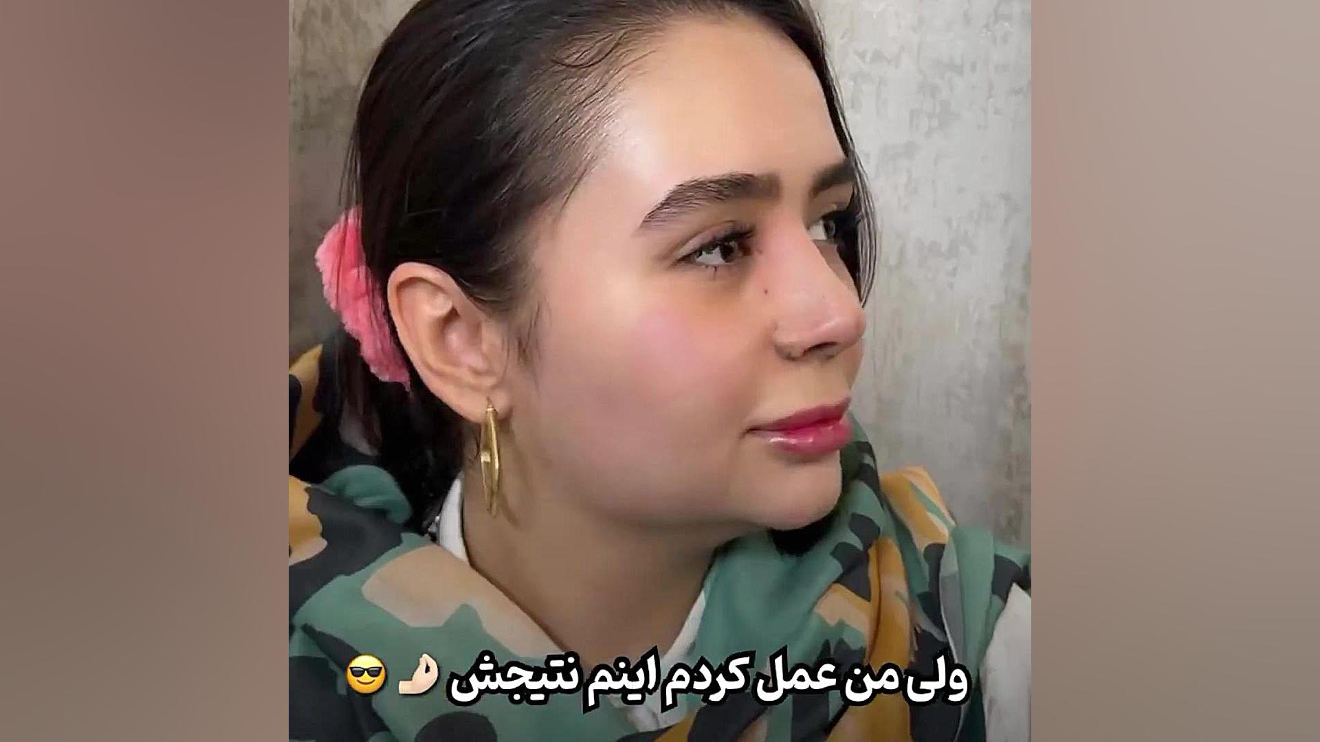 هیچوقت از عمل بینی پشیمون نمیشی دکتر علی عقیلی - جراح بینی در تهران