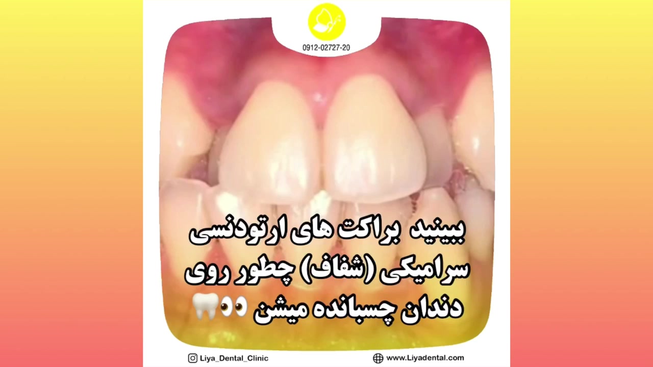 ارتودنسی اقساطی در دندانپزشکی لیا در سعادت آباد تهران 09120272720