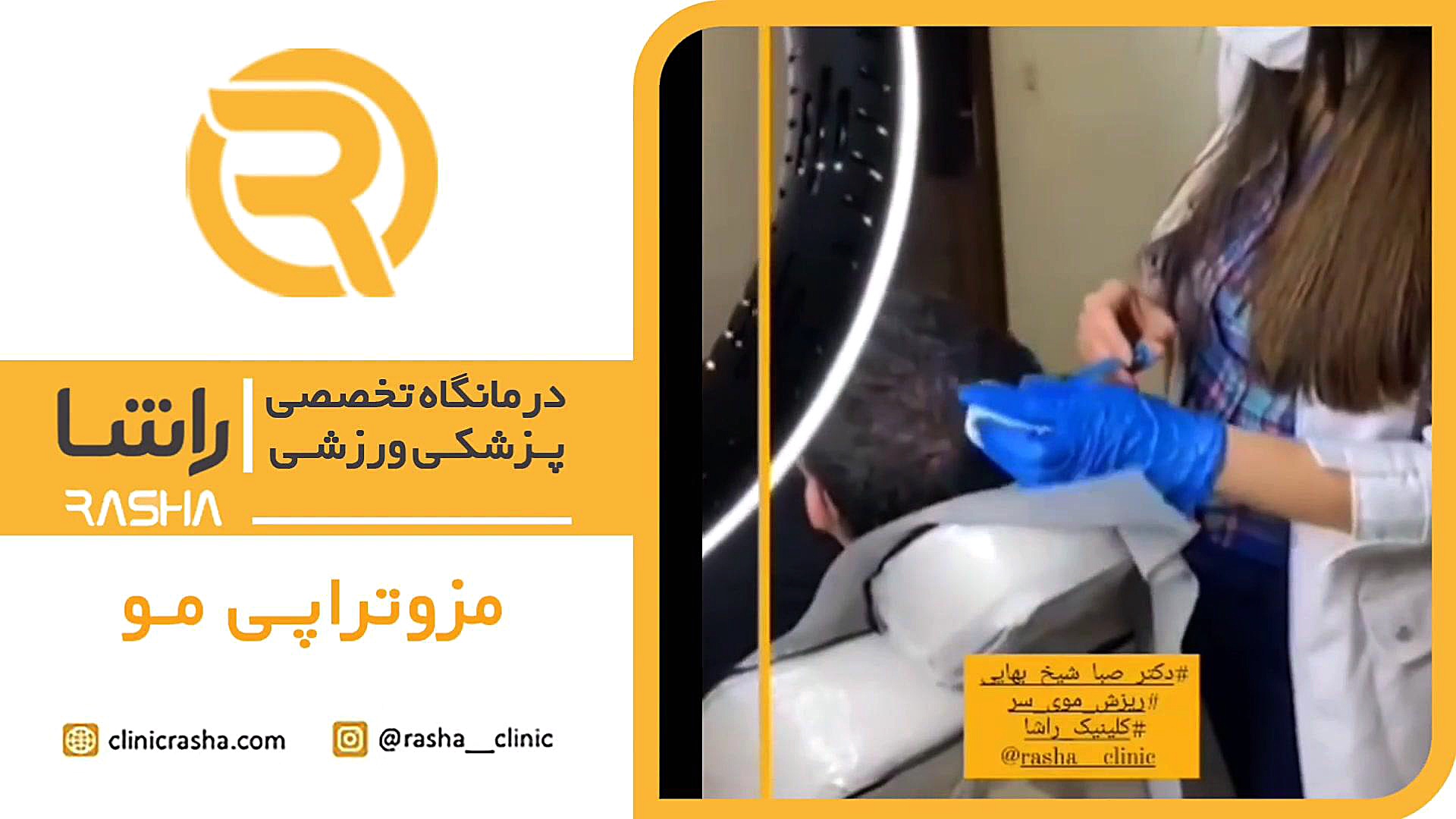 نمونه مزوتراپی مو در بهترین کلینیک زیبایی مو رتروگناتیا