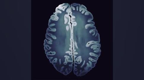 تسلا MRI بالاترین وضوح تصویر از مغز آکنه