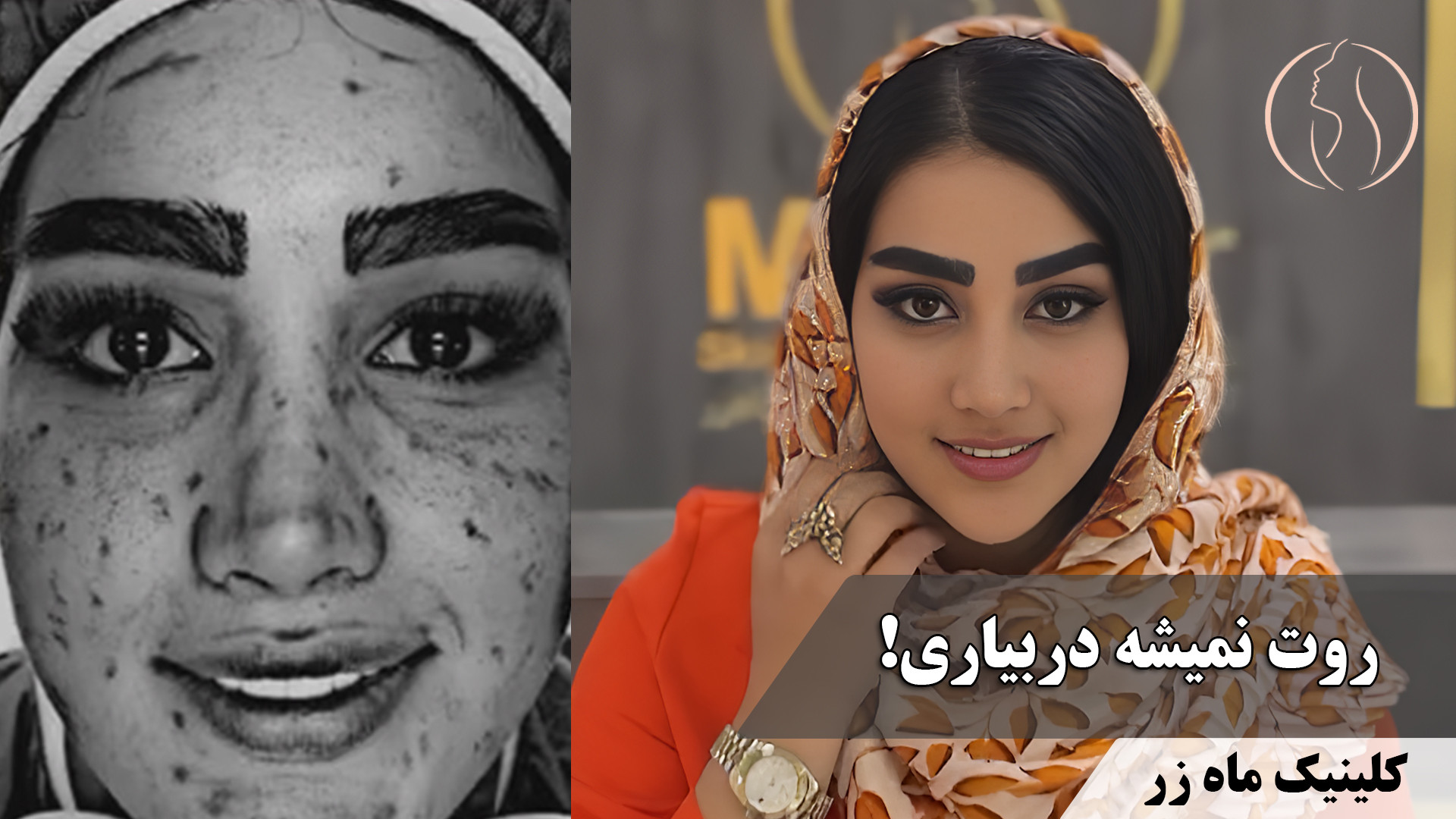 رفیق ناباب: جوش! ( کلینیک زیبایی ماه زر ) سندرم هرمون گیرنده مقاوم