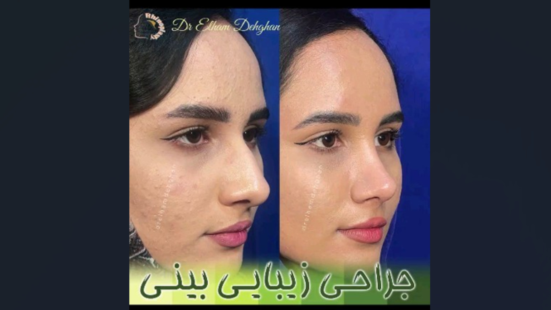 جراحی زیبایی بینی با نتایج عالی | دکتر الهام دهقان اتوپلاستی