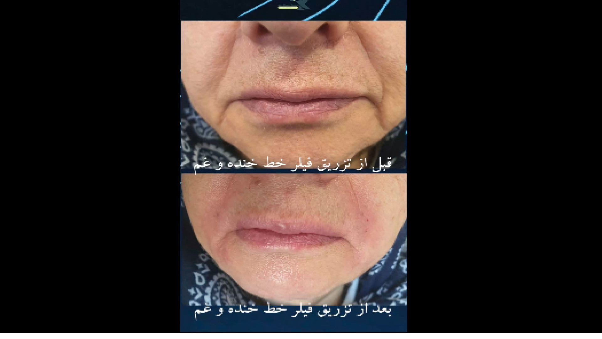 تزریق فیلر خط خنده دکتر ایمان روغنی جراح و متخصص پوست و مو