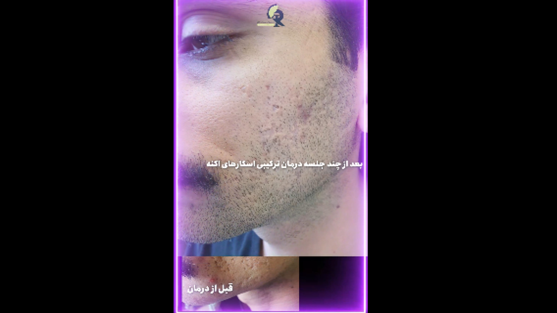 درمان اسکارهای اکنه دکتر ایمان روغنی جراح و متخصص پوست و مو