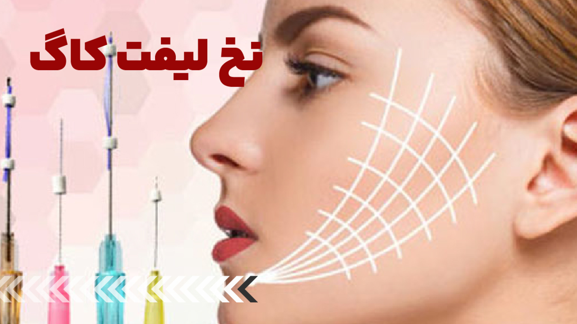 لیفت با نخ کاگ کامپوزیت ونیر