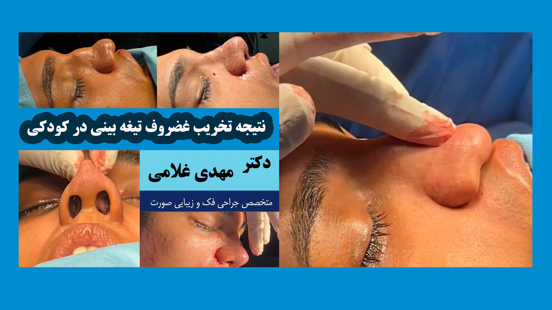 نتیجه تخریب غضروف تیغه بینی در کودکی دکتر مهدی غلامی