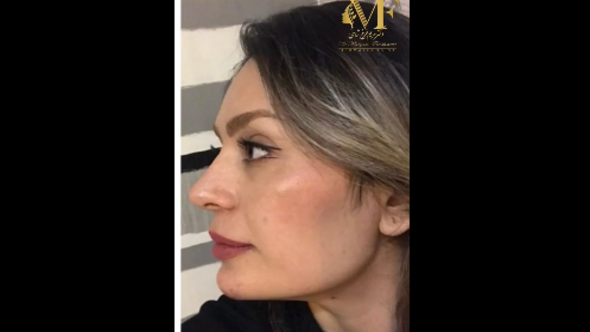 تزریق ژل زاویه فک، گونه و چانه دکتر مریم فرخشاهی - پوست، مو و زیبایی