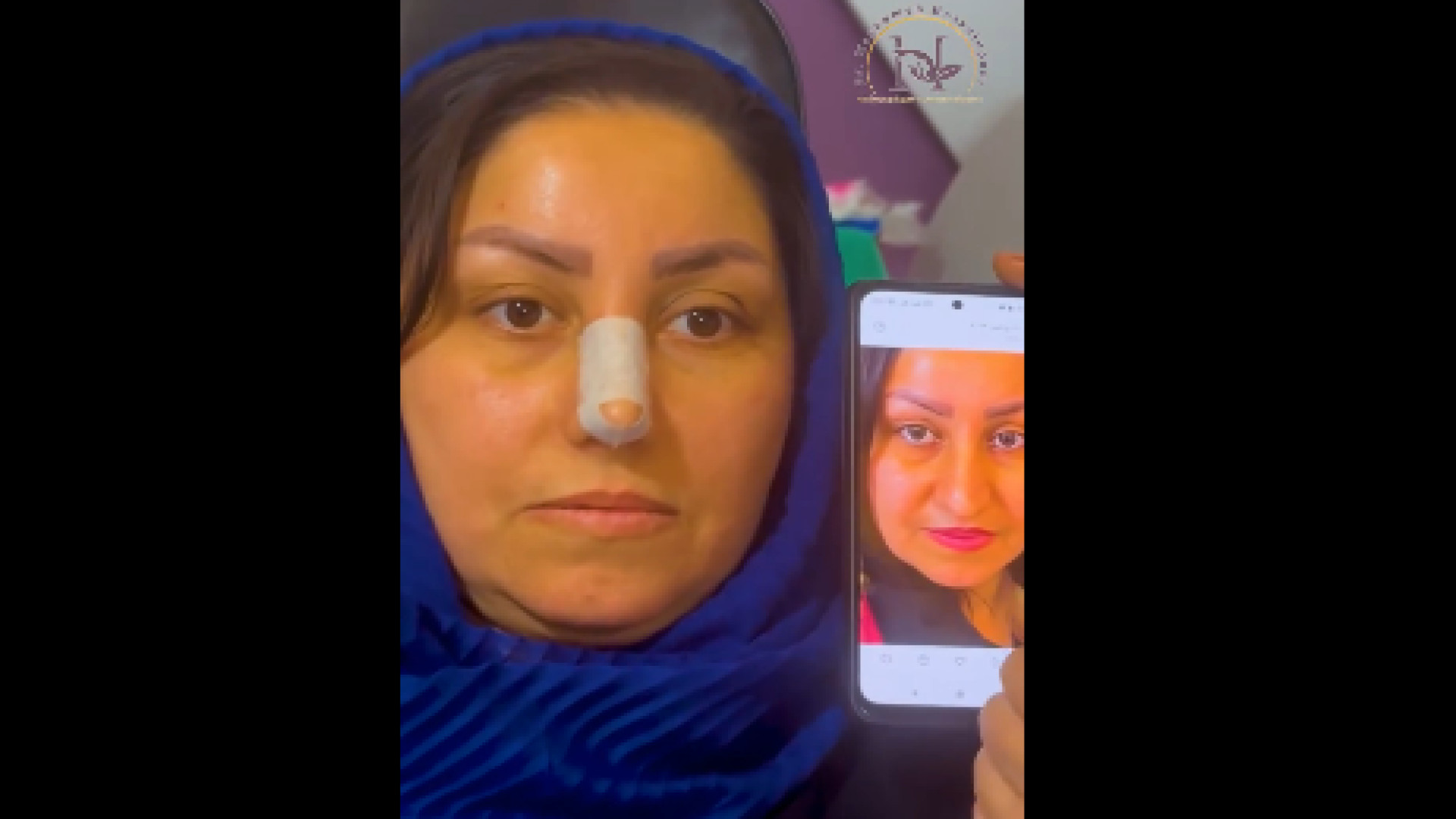 تزریق نیم سی سی ژل لب دکتر معصومه حسین پور