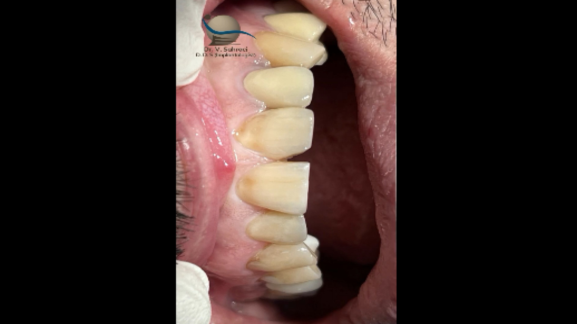 ترمیم بدشکلی و پوسیدگی دندان ترمیم سوختگی