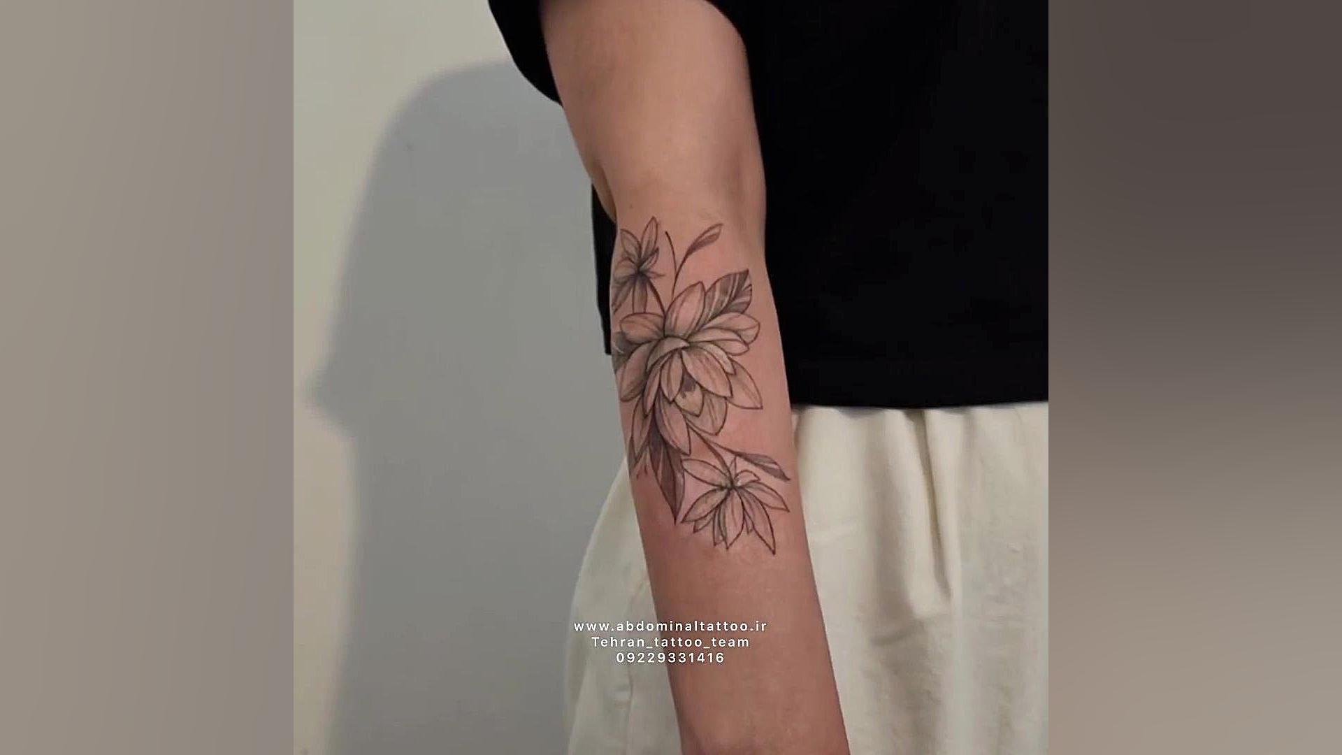 تتو روی سوختگی دست و پوشیده شدن کامل سوختگی لیزر مو