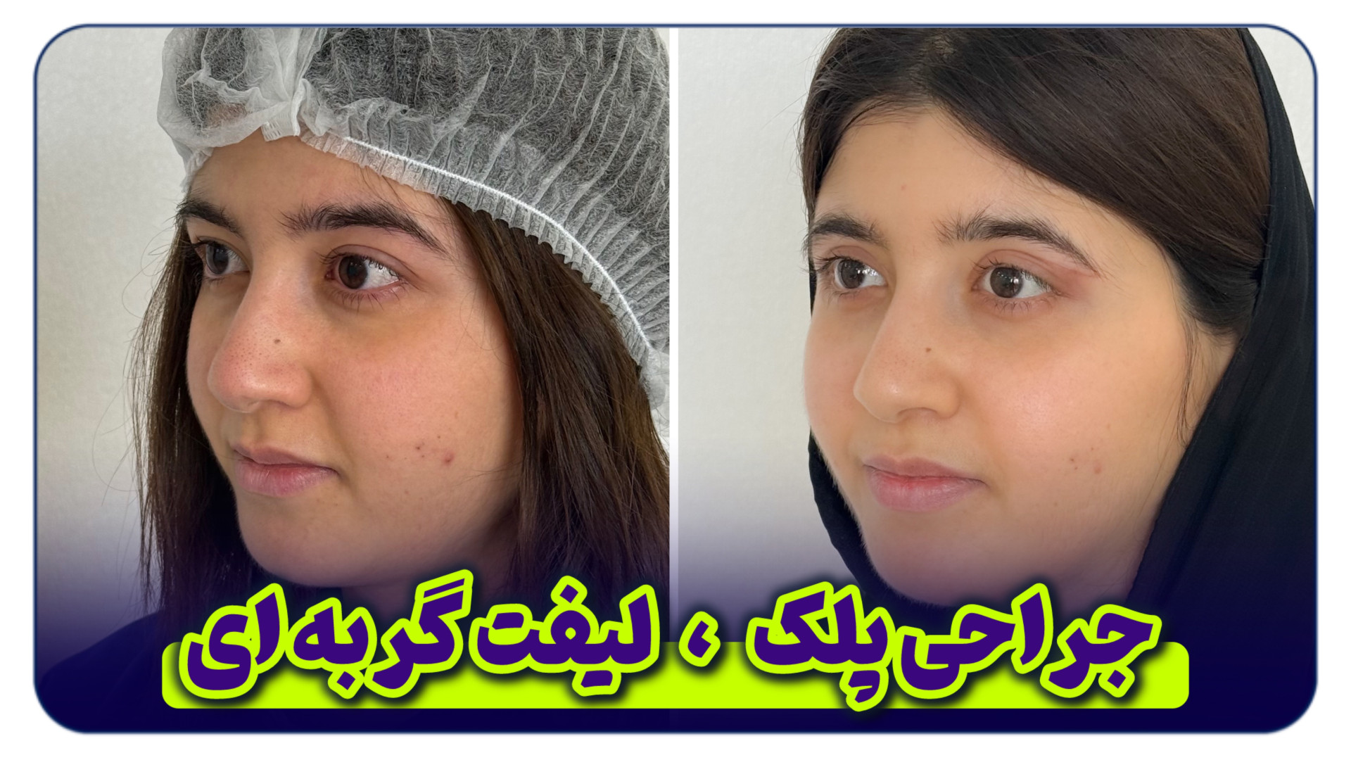 بلفاروپلاستی چشم گربه ای با بخیه لیزری بلفالوکس لیفت گردنایمپلنت دندان