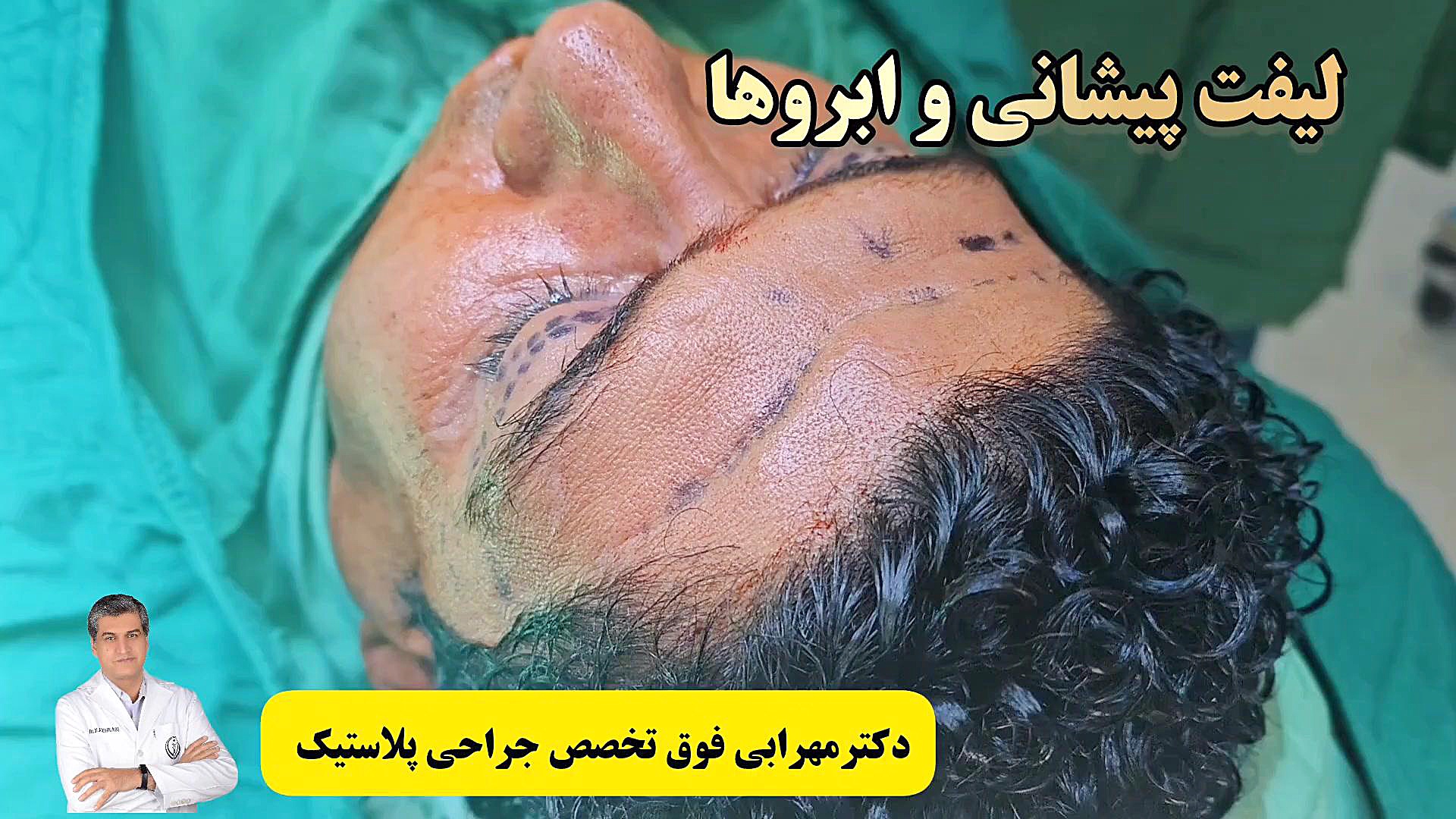 لیفت پیشانی و ابرو #لیفتینگ_صورت #شیراز #دکترمهرابی دکتر محمد مهدی مهرابی جراح پلاستیک و زیبایی