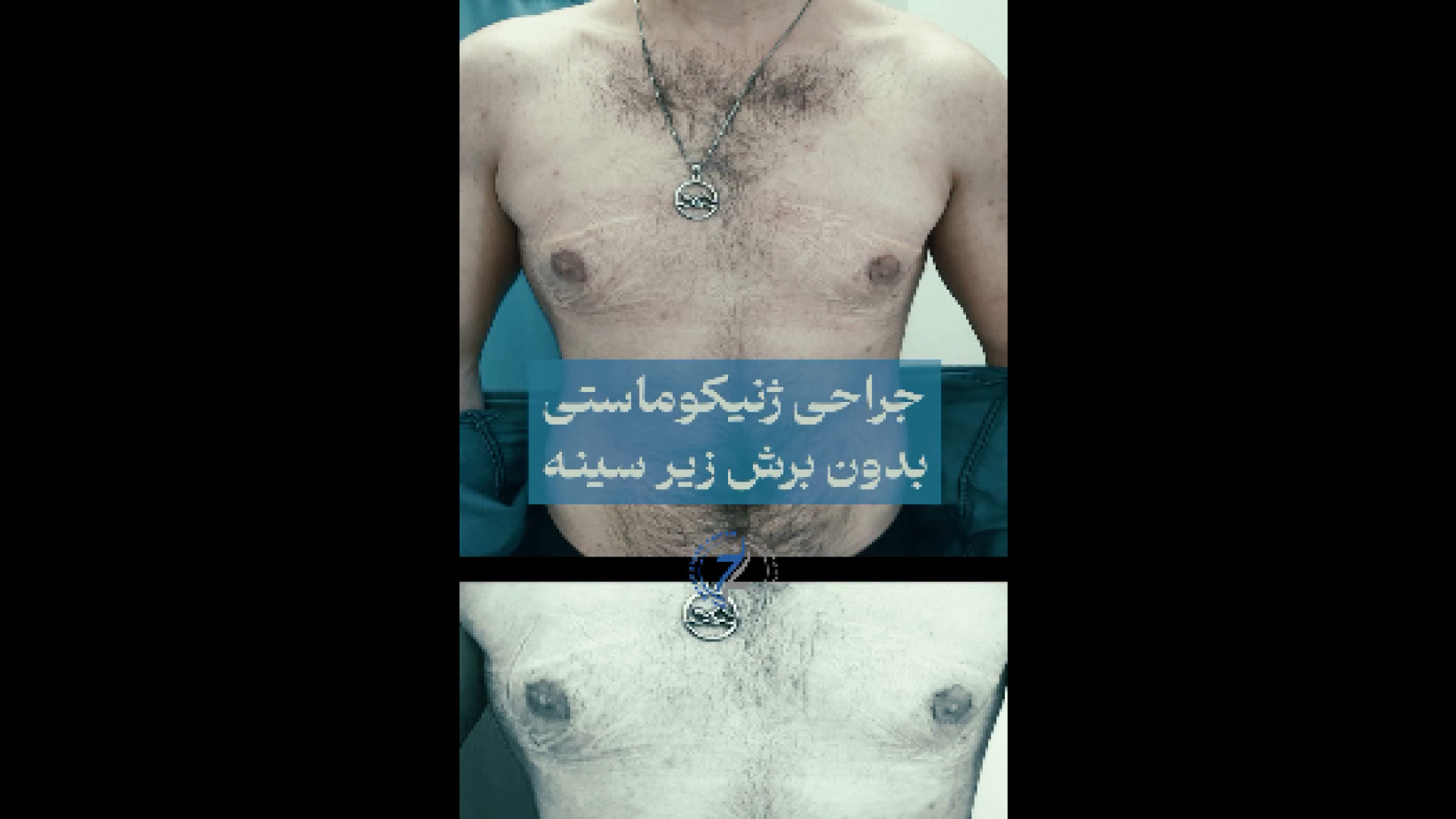 قبل و بعد ژنیکوماستی مردانه دکتر هاتف زیرک زاده - فوق تخصص جراحی پلاستیک
