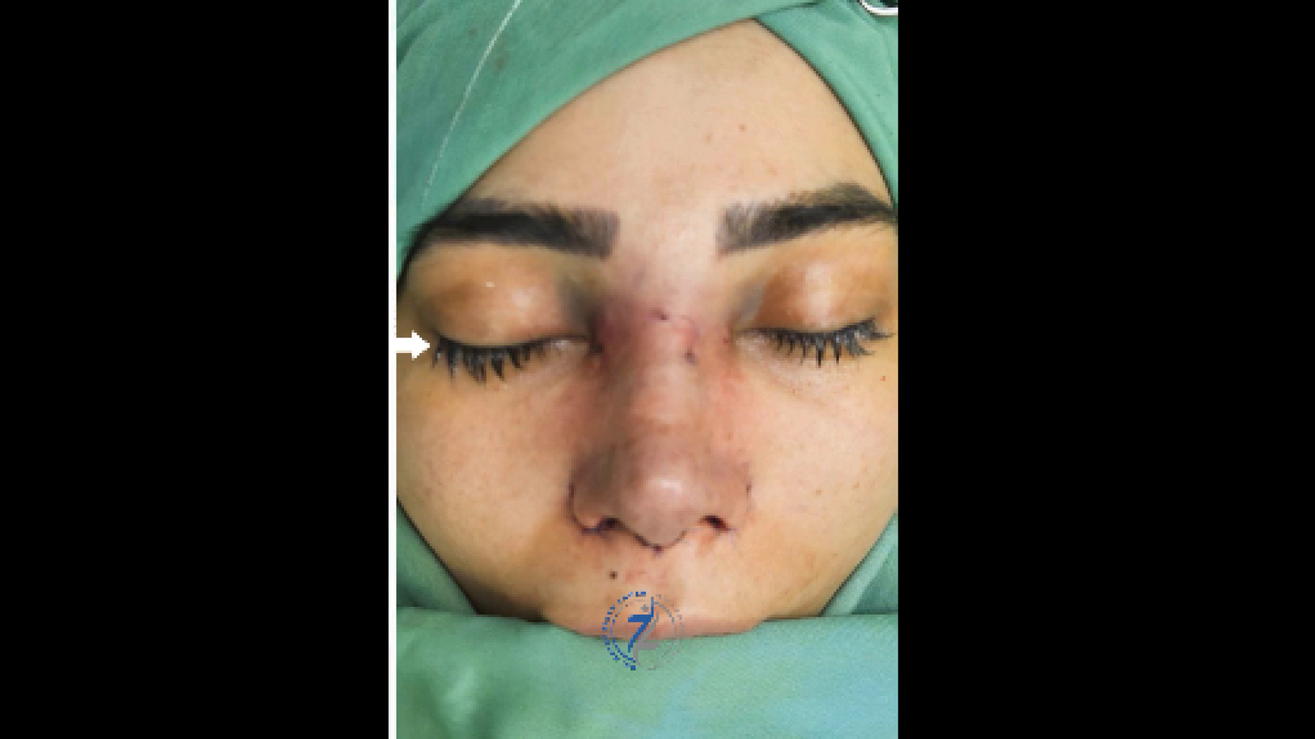 بلافاصله بعد از جراحی رینوپلاستی دکتر هاتف زیرک زاده - فوق تخصص جراحی پلاستیک