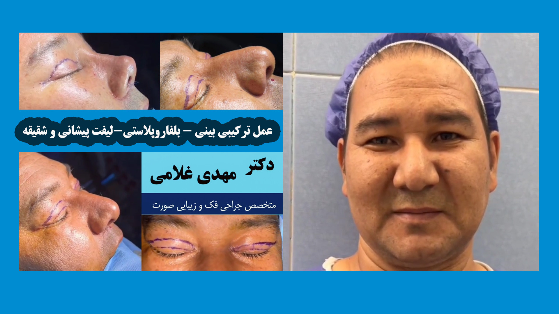 عمل ترکیبی بینی، بلفاروپلاستی و لیفت با دکتر مهدی غلامی در مشهد دکتر مهدی غلامی