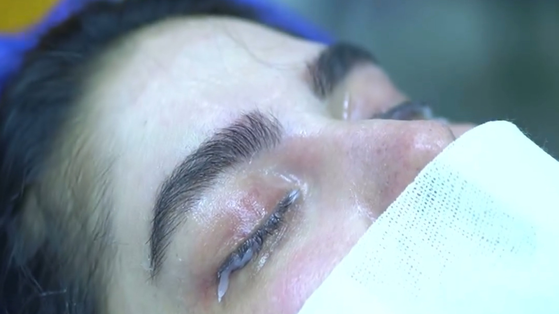 علت پماد زدن چشم قبل از جراحی دکتر حسین پناه