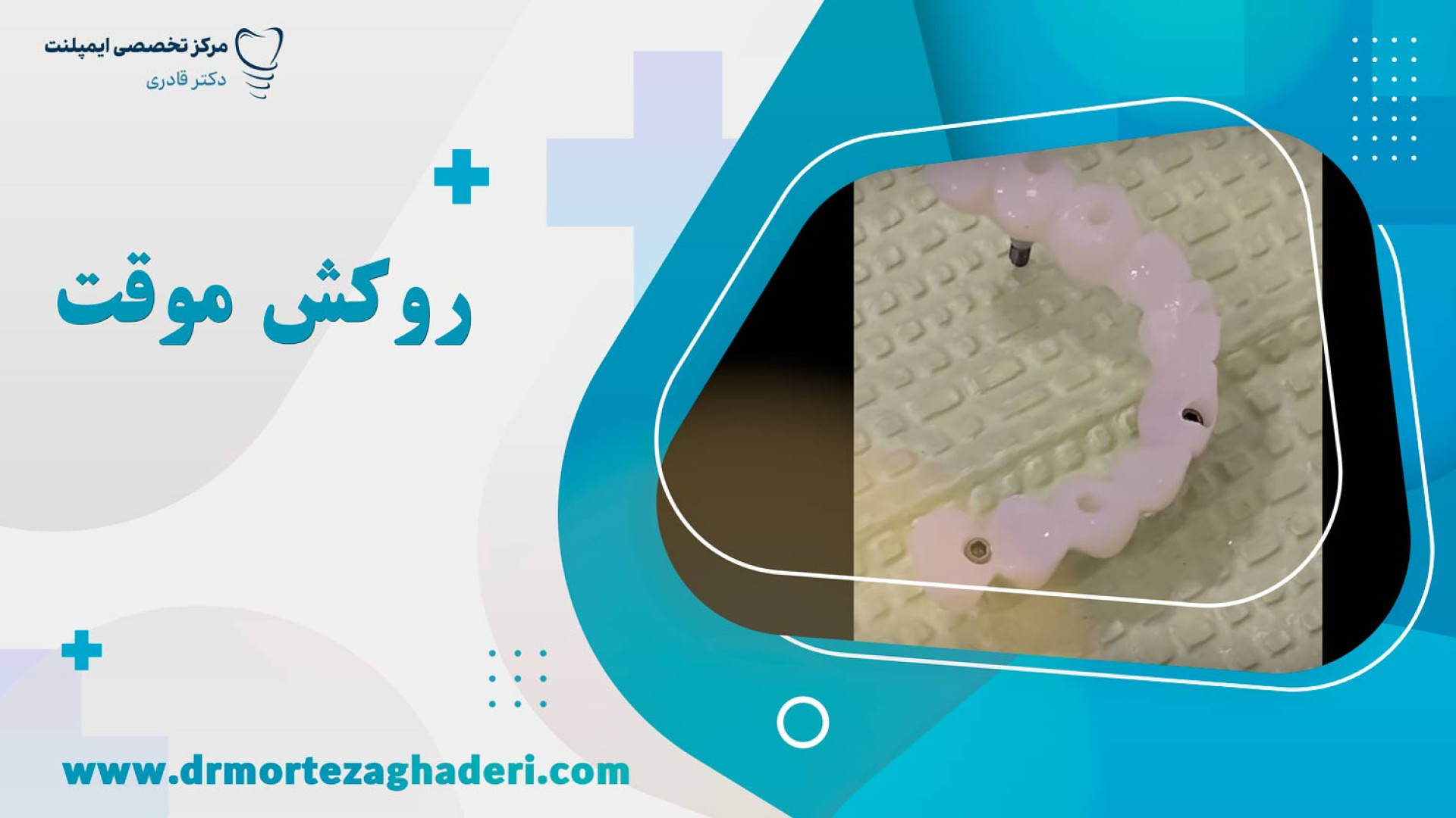 روکش موقت فوری برای ایمپلنت دندان RF Test