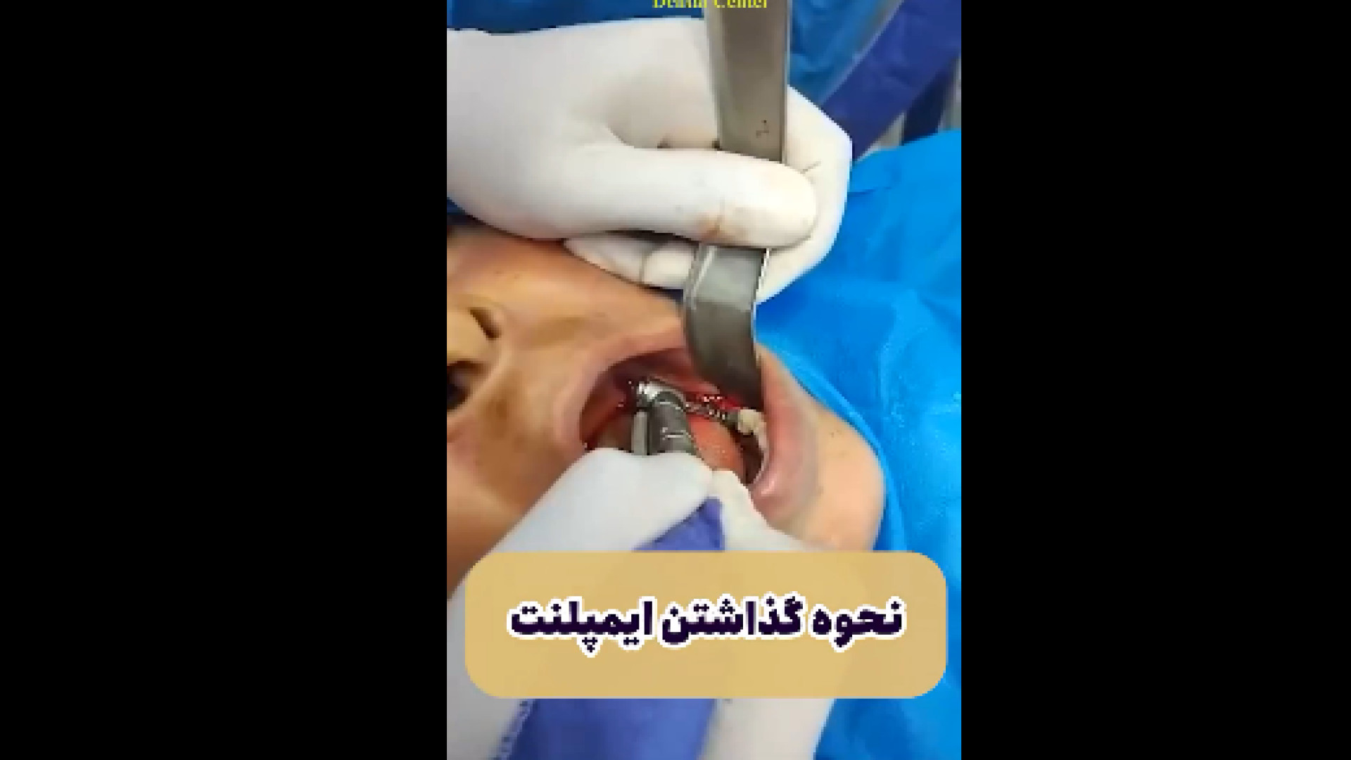 نحوه ی گذاشتن ایمپلنت دکتر زهرا رخ فروز
