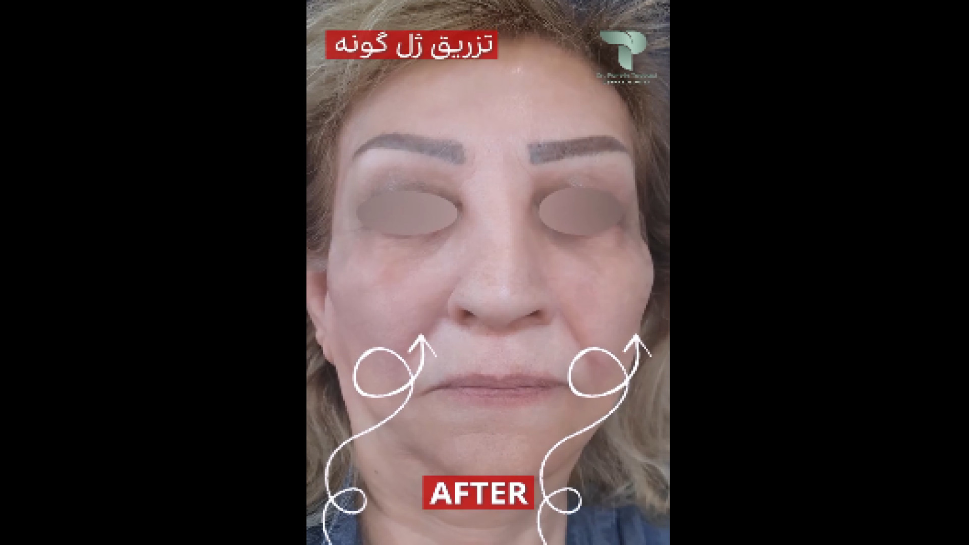 تزریق ژل گونه دکتر پروین طاوسی - متخصص پوست، مو و زیبایی