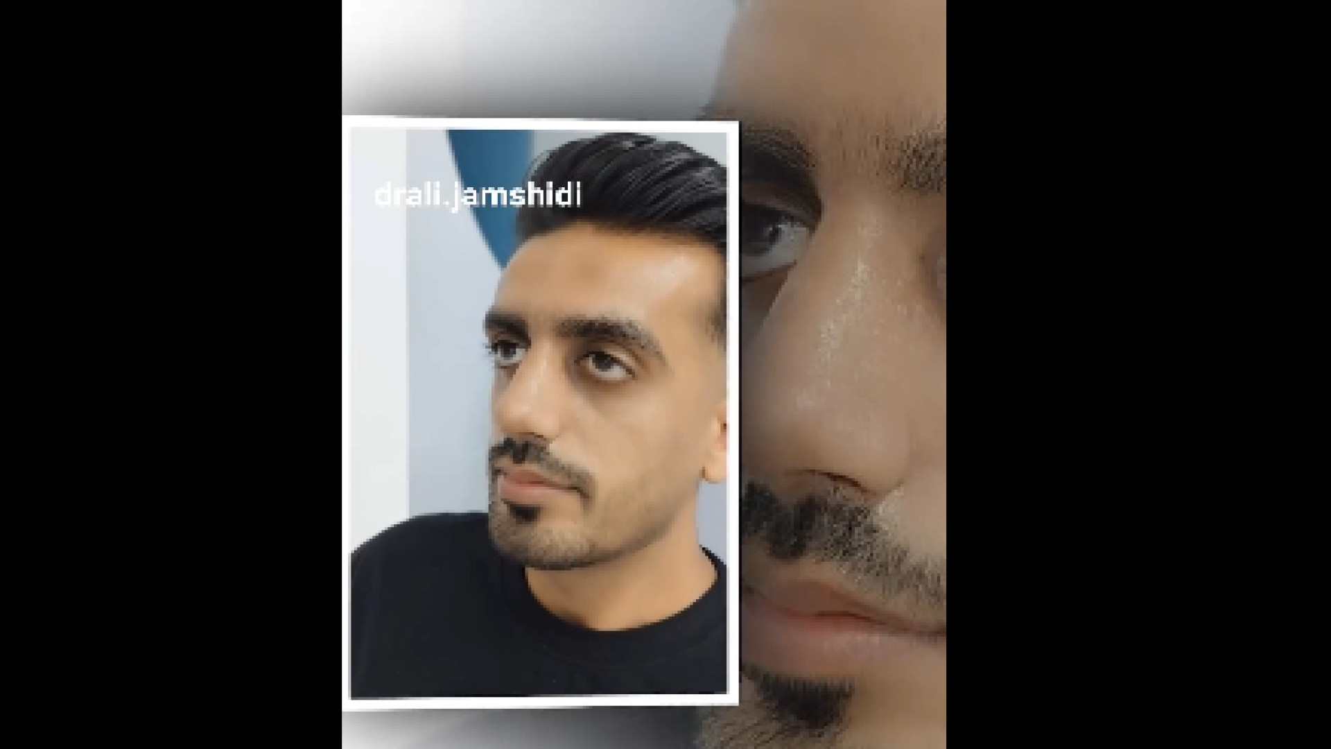 نتیجه عمل بینی جذاب دکتر علی جمشیدی