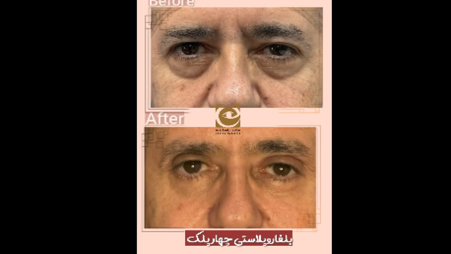 بلفاروپلاستی چهار پلک سیامک انصاری