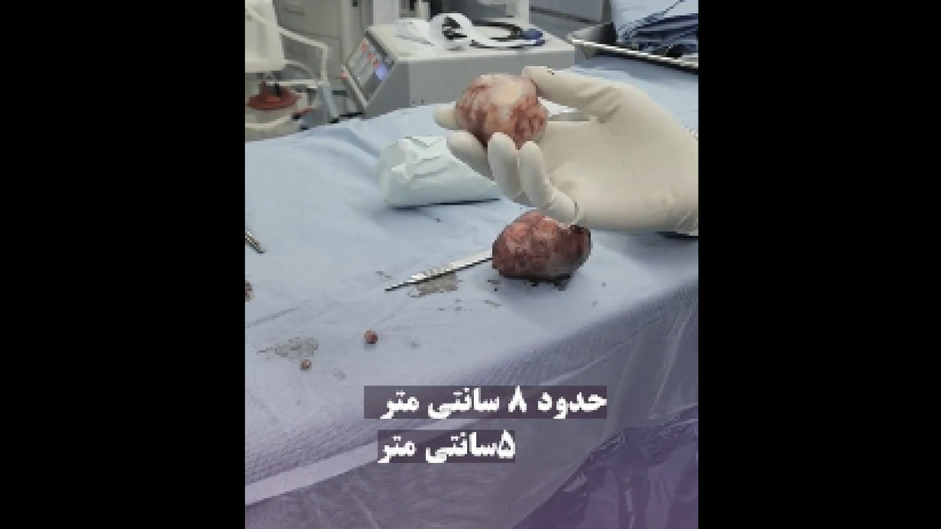 جراحی فیبروم 8 سانتی ترمیم ونیر