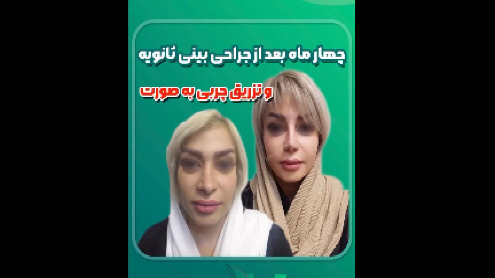 نتیجه جراحی بینی و تزریق چربی دکتر محمودرضا اصحاب یمین - فوق تخصص پلاستیک