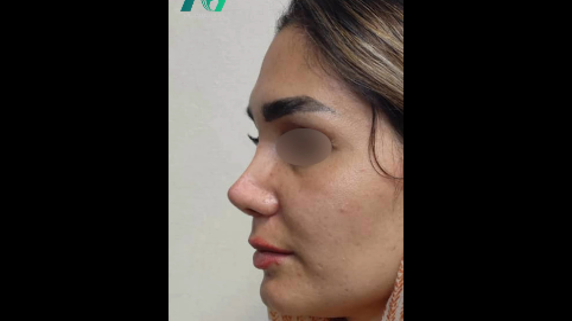 جراحی بینی گوشتی دکتر محمودرضا اصحاب یمین - فوق تخصص پلاستیک