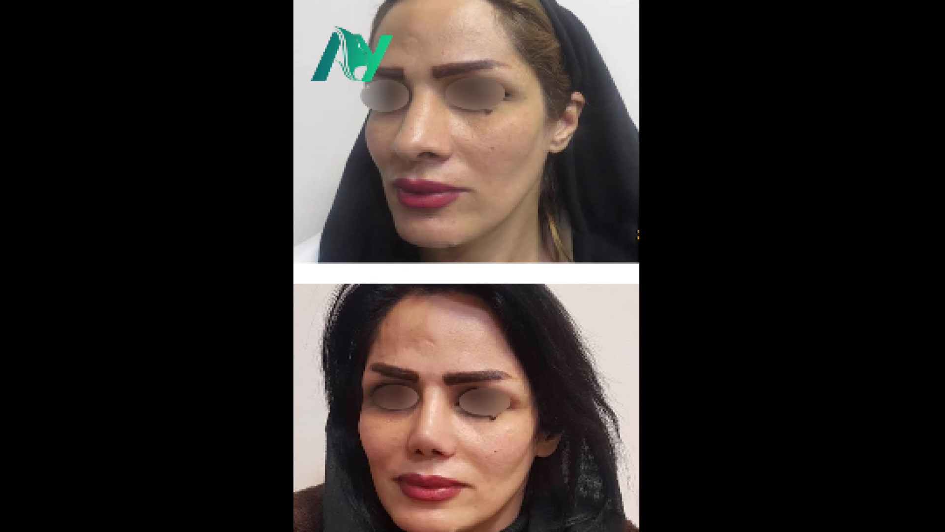 عمل بینی فانتزی دکتر محمودرضا اصحاب یمین - فوق تخصص پلاستیک