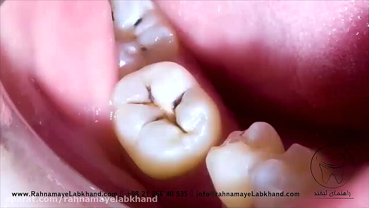 پر کردن دندان ترومبوسیتوپنی مقاوم