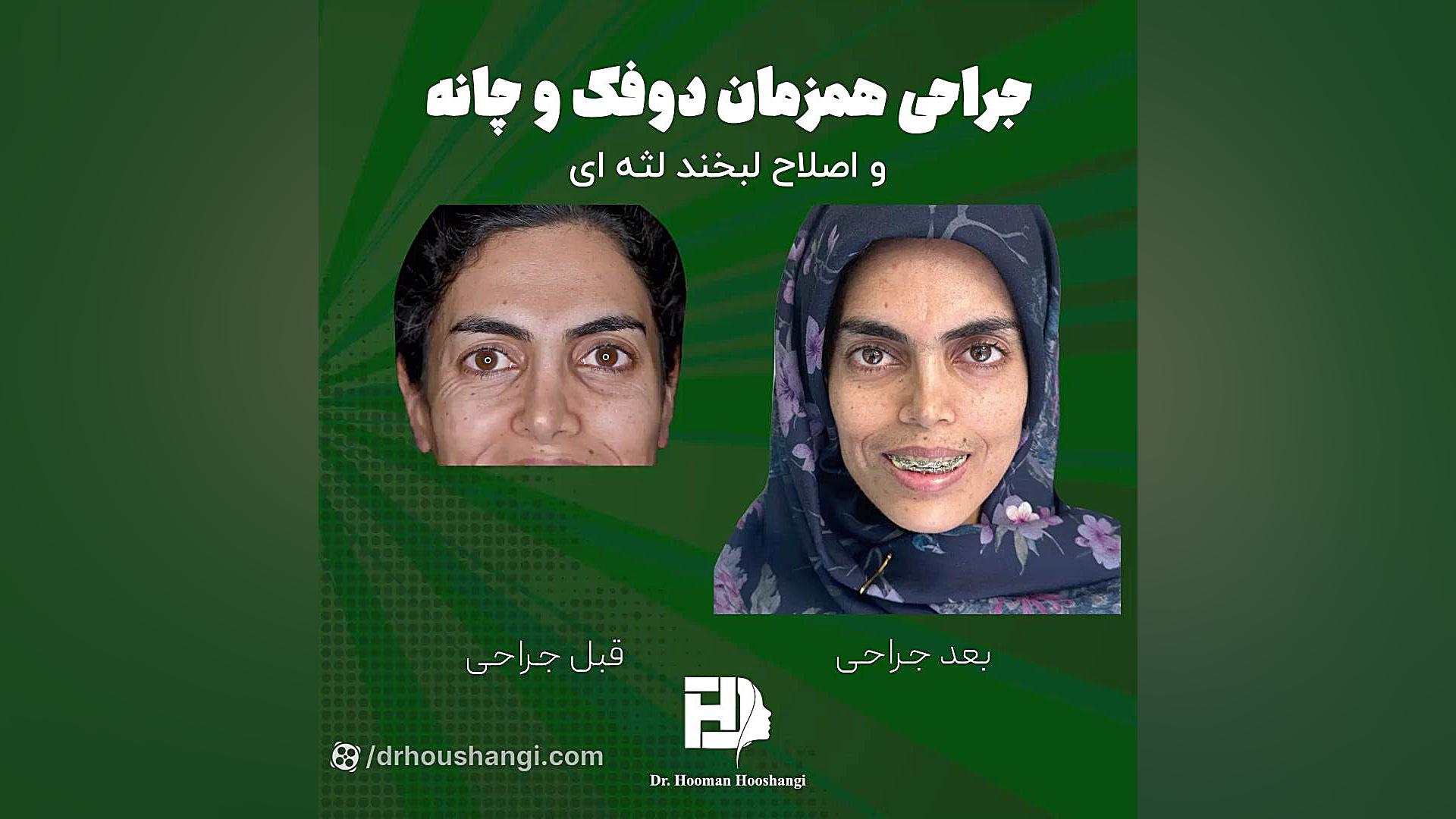 جراحی همزمان دو فک و چانه دندانپزشک زیبایی