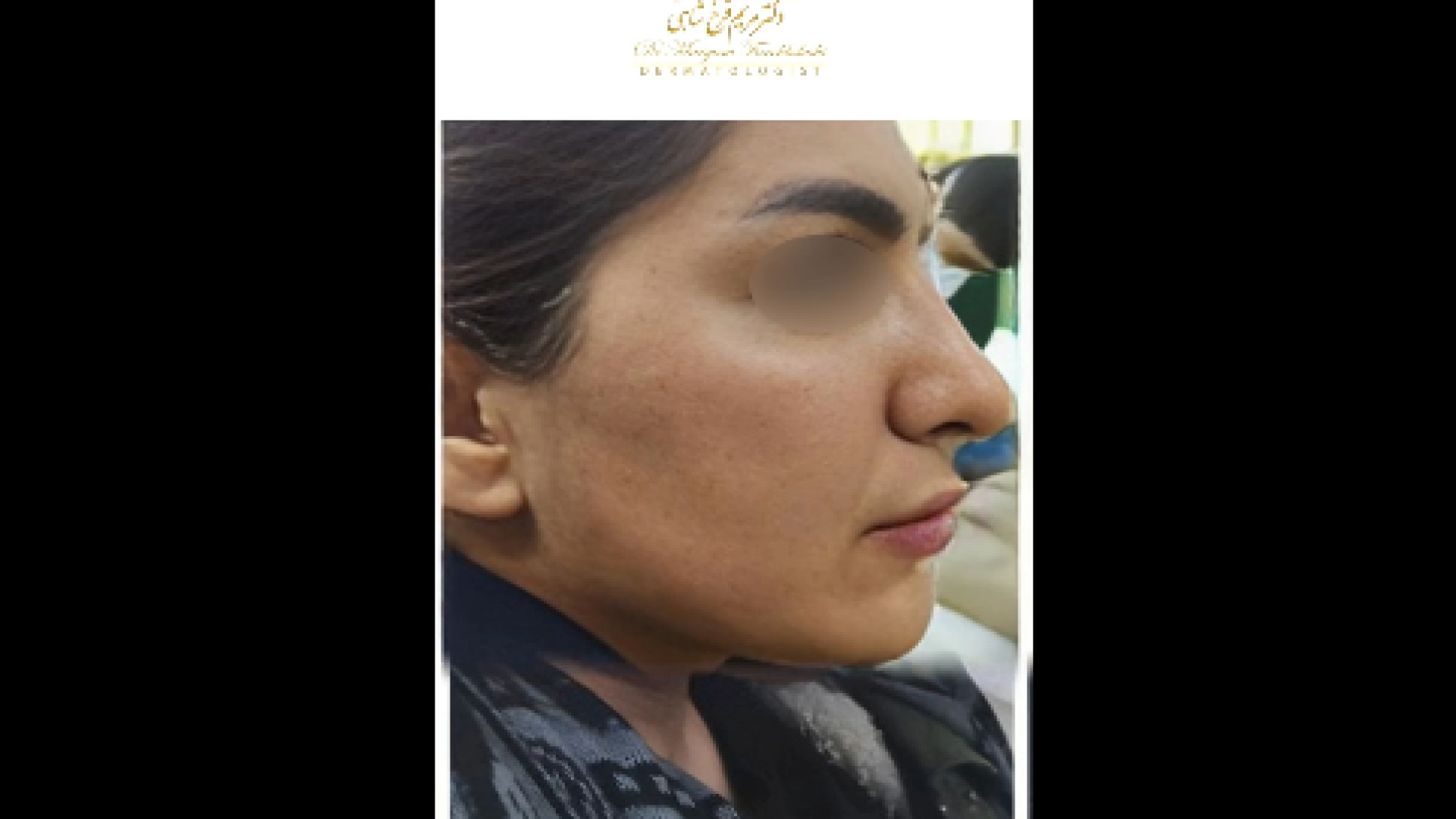 نمونه کار تزریق ژل به صورت دکتر مریم فرخشاهی - پوست، مو و زیبایی