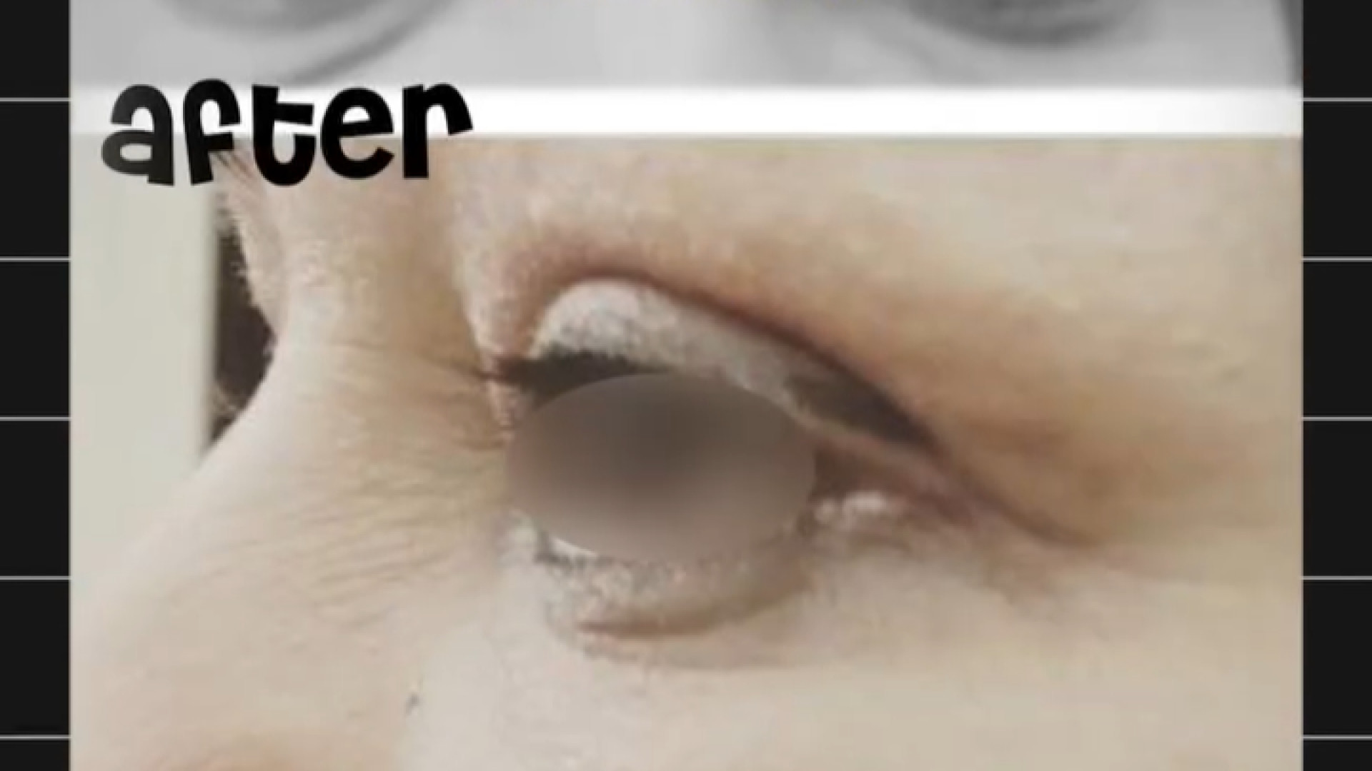 نمونه کار بلفاروپلاستی دکتر مریم فرخشاهی - پوست، مو و زیبایی