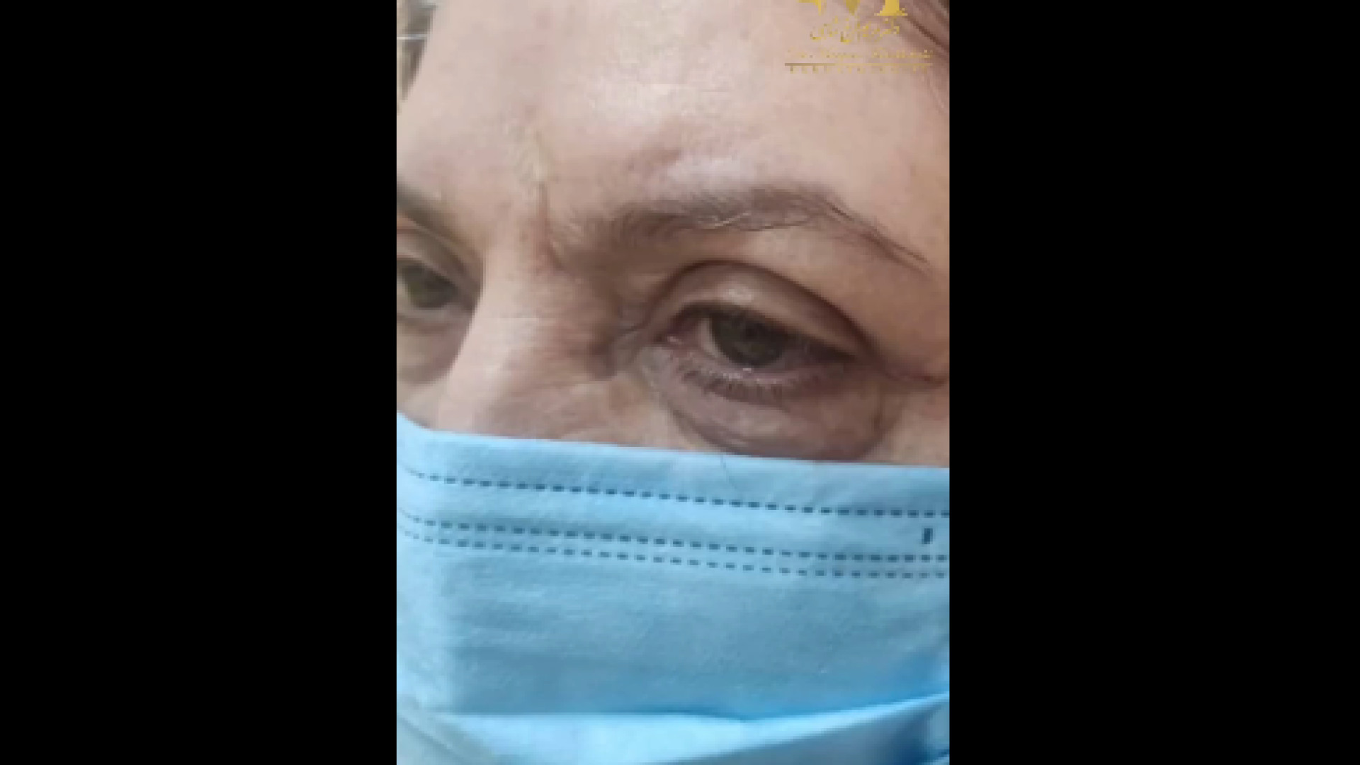 نتیجه عمل بلفاروپلاستی دکتر مریم فرخشاهی - پوست، مو و زیبایی