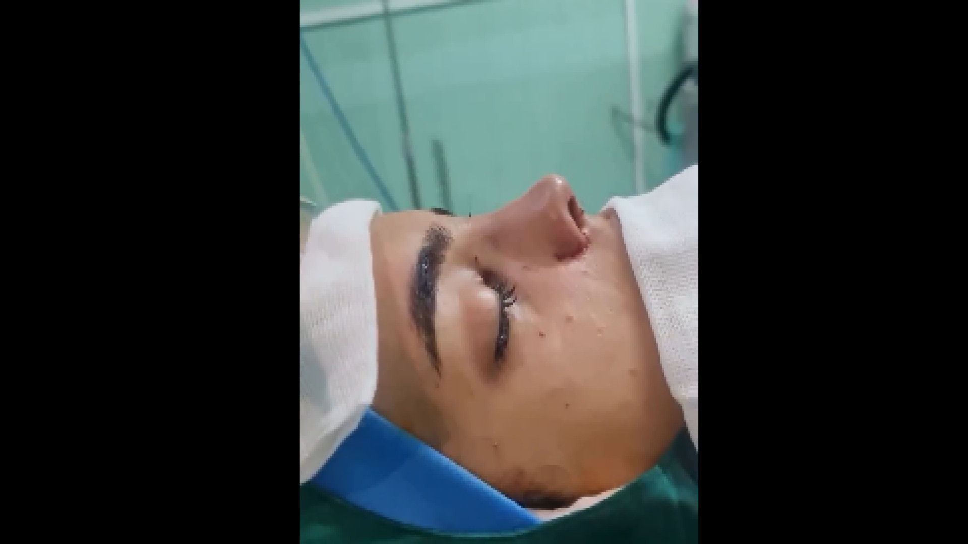 عمل بینی نیمه طبیعی دکتر شاهین بهجو - فوق تخصص جراحی پلاستیک