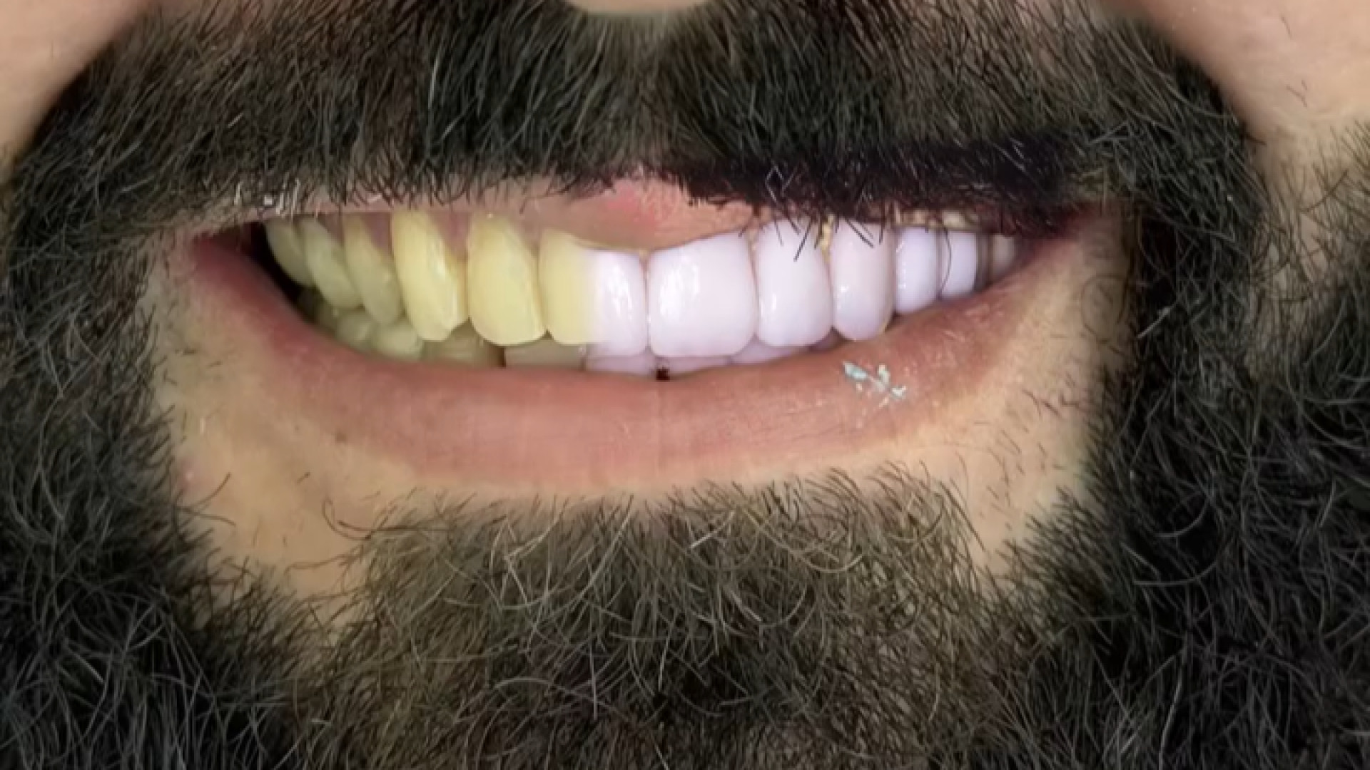 نمونه کار زیبایی دندان Screening Lentiviral Vector