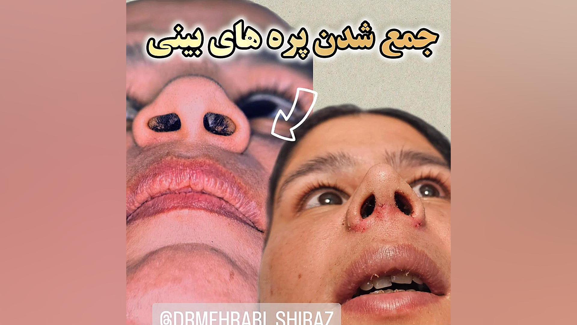 جراحی پره بینی بینی پهن شیراز دکتر مهرابی دکتر محمد مهدی مهرابی جراح پلاستیک و زیبایی