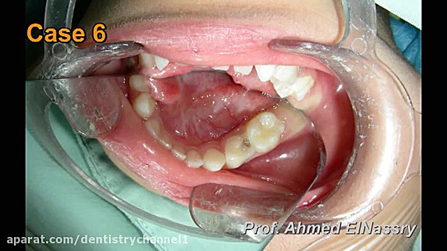 ترمیم کمپوزیتی دندان های شیری قدامی ترمیم سوختگی