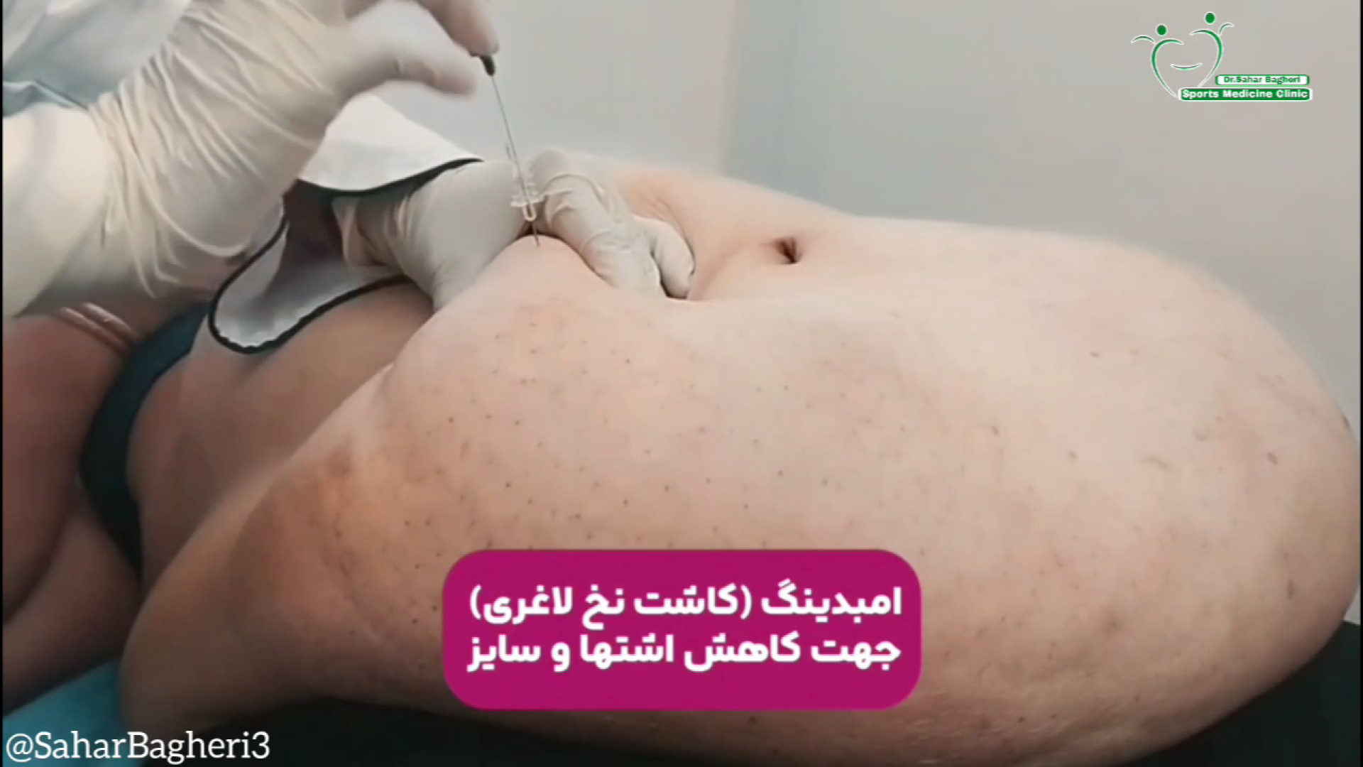 امبدینگ (کاشت نخ لاغری) دکتر سحر باقری ـ متخصص پزشکی ورزشی