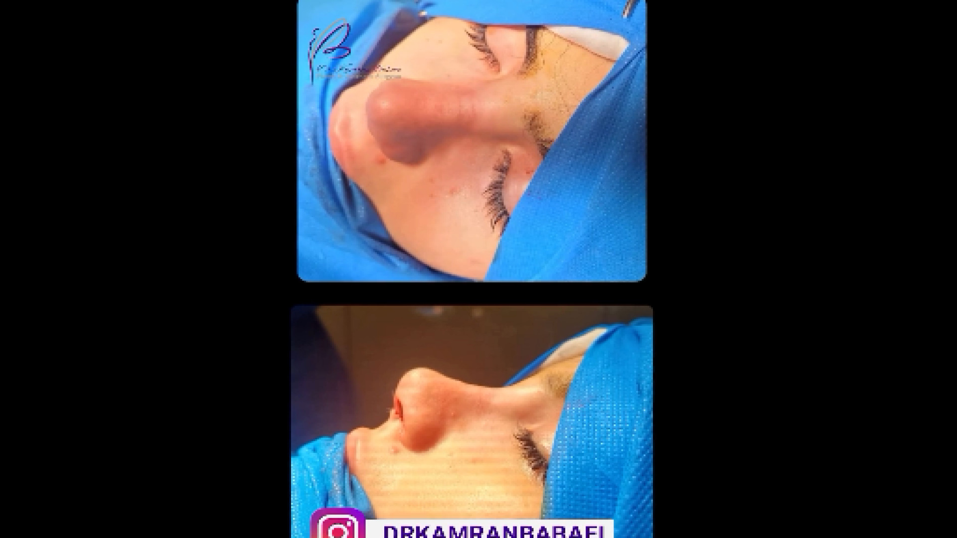 نمونه جراحى زيبايى بينى دکتر کامران بابایی