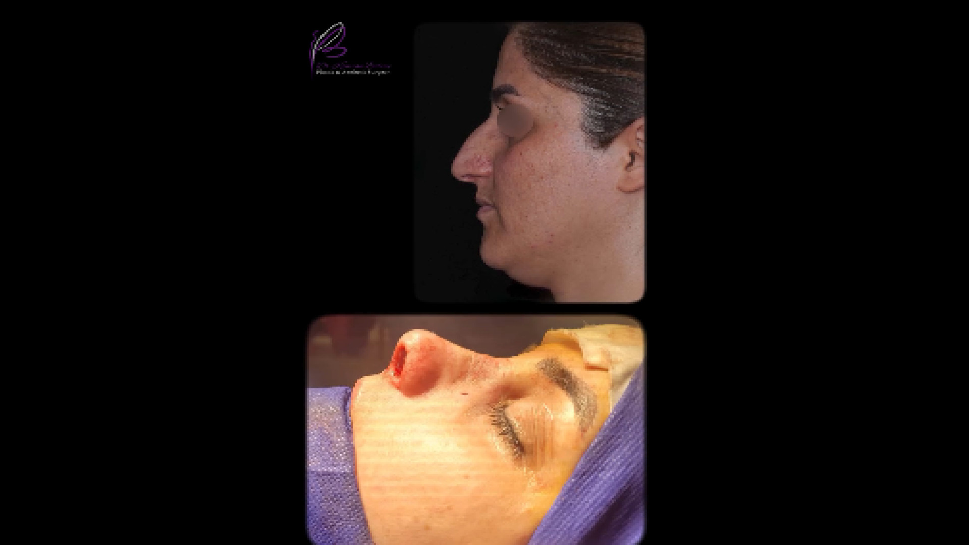 نتیجه بلافاصله بعد از عمل بینی دکتر کامران بابایی